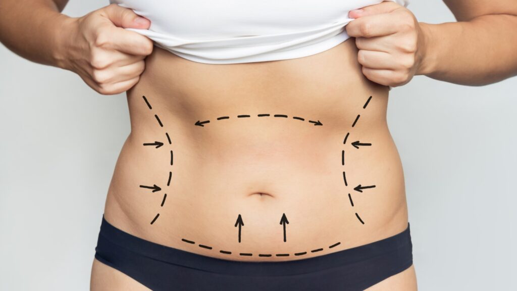 Stomach Pattern for Advanced Liposuction in Utah