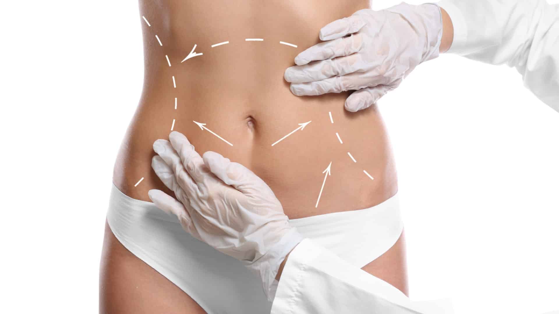 doctor outlining liposuction