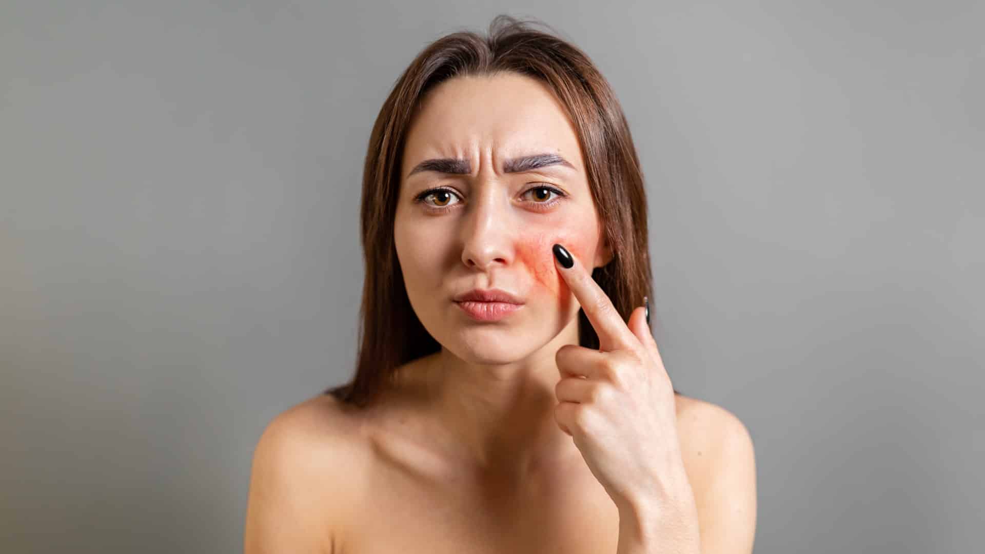 woman pointing to rosacea