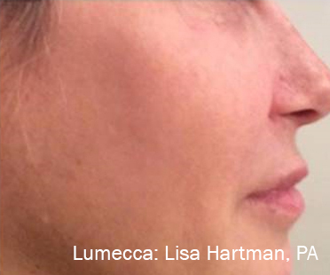 lumecca-before-after-dr-l-hartman-preview-1after