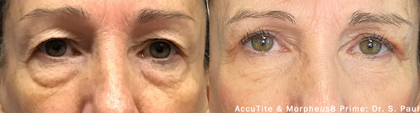 accutite-morpheus-prime-before-after-dr-s-paul-preview-1 (Custom)