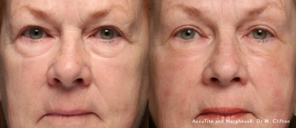 accutite-morpheus8-before-after-dr-m-clifton-preview-1 (Custom)