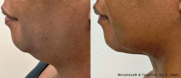 facetite-morpheus8-before-after-dr-c-cash-preview-1 (Custom)