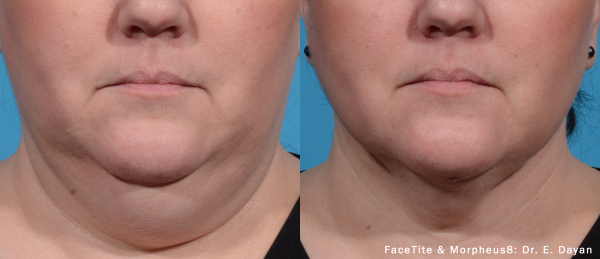 facetite-morpheus8-before-after-dr-e-dayan-preview-1 (Custom)