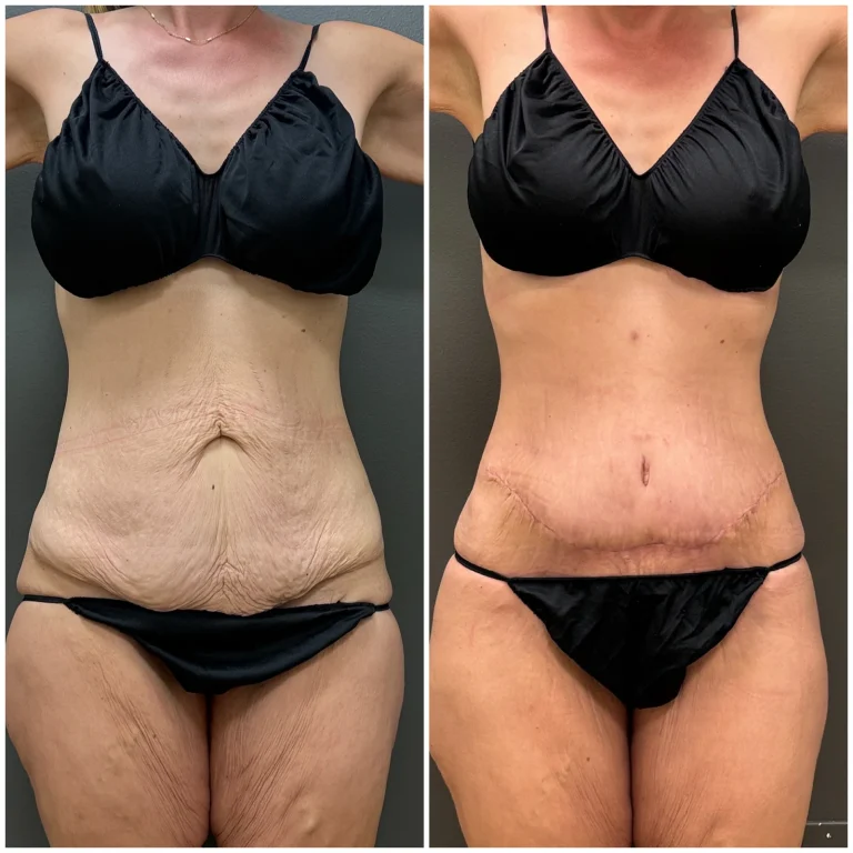 BodyPoint BodyTite Plus with liposuction: before left and three months after right, front view.