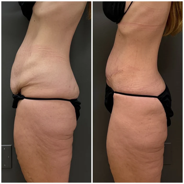 BodyPoint BodyTite Plus with liposuction: before left and three months after right, side view.