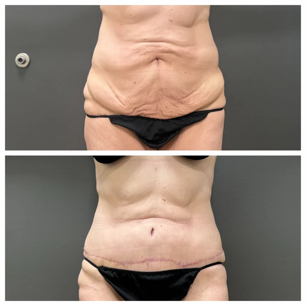 BodyPoint BodyTite Plus with liposuction, front comparison; before top and three months after bottom. Individual results vary.