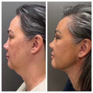 FaceTite with light liposuction and one Morpheus8 treatment at BodyPoint in Lehi: before on the left and three months after on the right.