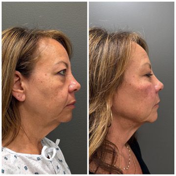 FaceTite with light liposuction and one Morpheus8 treatment at BodyPoint in Lehi: before on the left and three months after on the right.