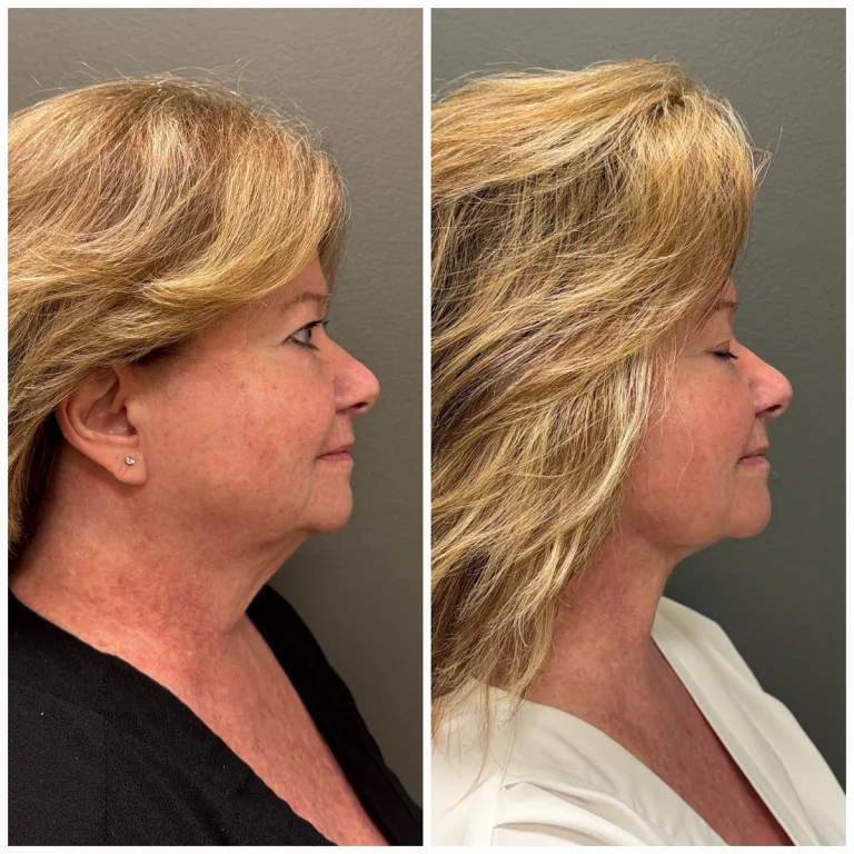 BodyPoint FaceTite with light liposuction and one Morpheus8 treatment: before left and three months after right.