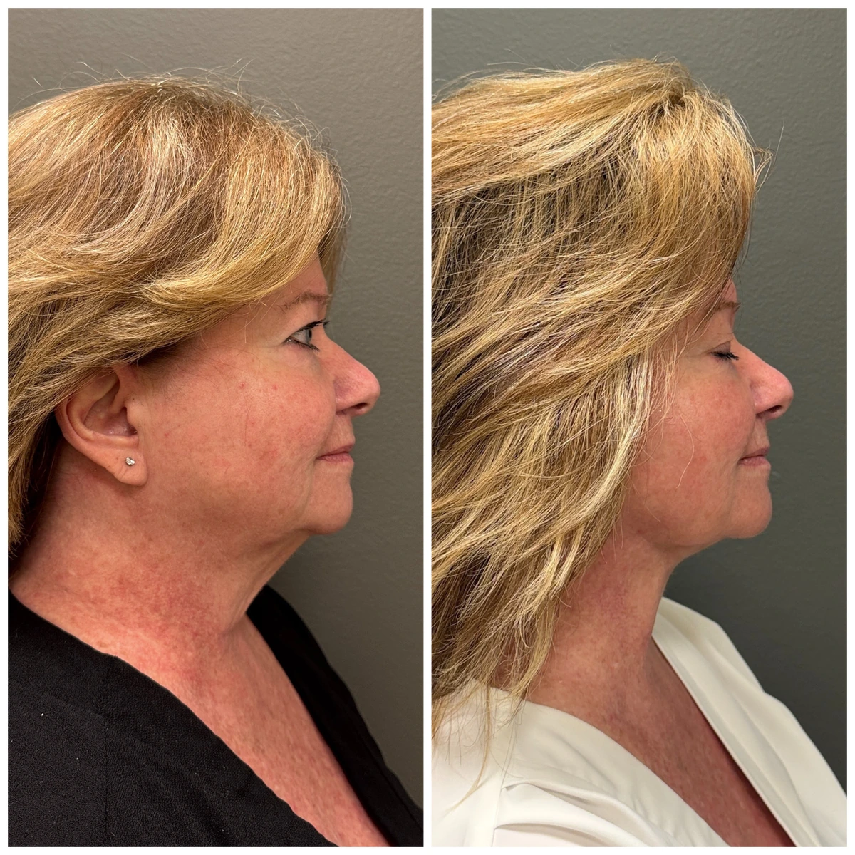 FaceTite with light liposuction and one Morpheus8 treatment at BodyPoint in Lehi: before on the left and three months after on the right.