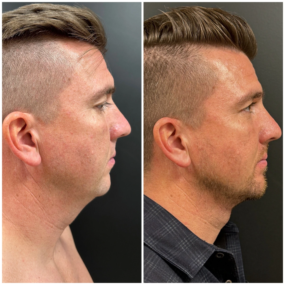 FaceTite with light liposuction and one Morpheus8 treatment at BodyPoint in Lehi: before on the left and three months after on the right.