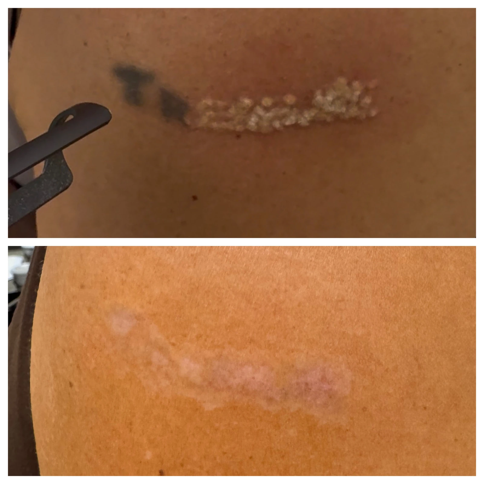 Patient tattoo comparison: top before; bottom after 4 treatments.