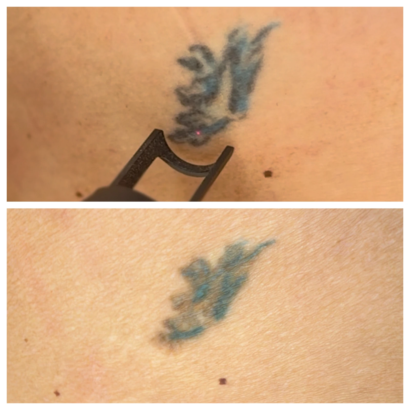 Patient tattoo comparison: top before; bottom after 2 treatments; treatment ongoing.